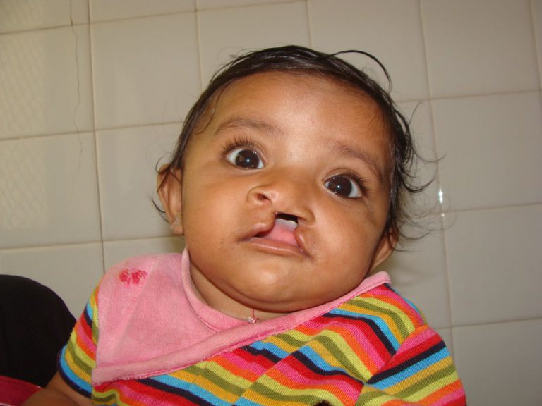 cleft child before operation